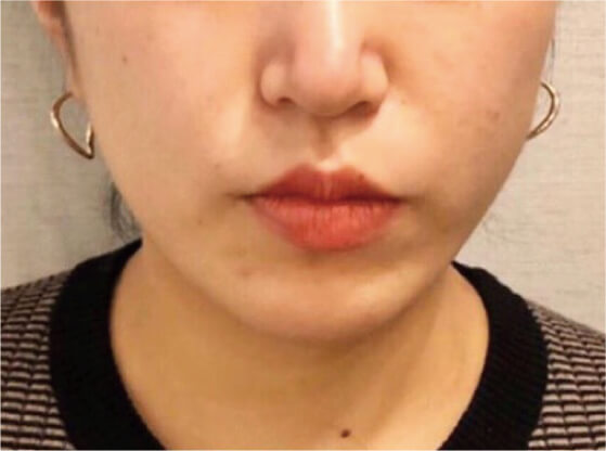 全顔ダブルコース施術前