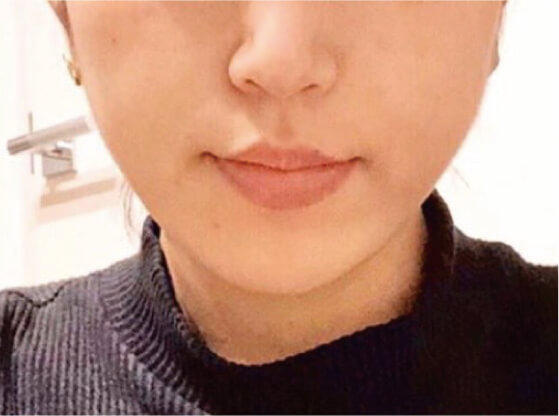 全顔ダブルコース施術後