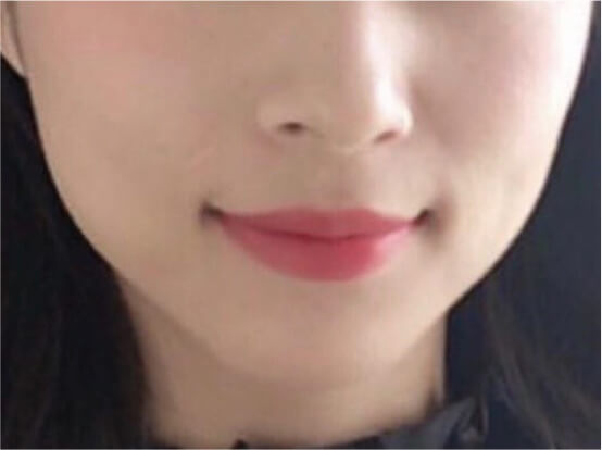 全顔ダブルコース施術前